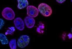 Metastasis Cancer Image 